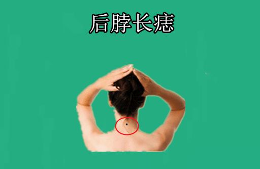 脖子后面长痣有什么寓意吗（解读脖子后长痣的象征意义）